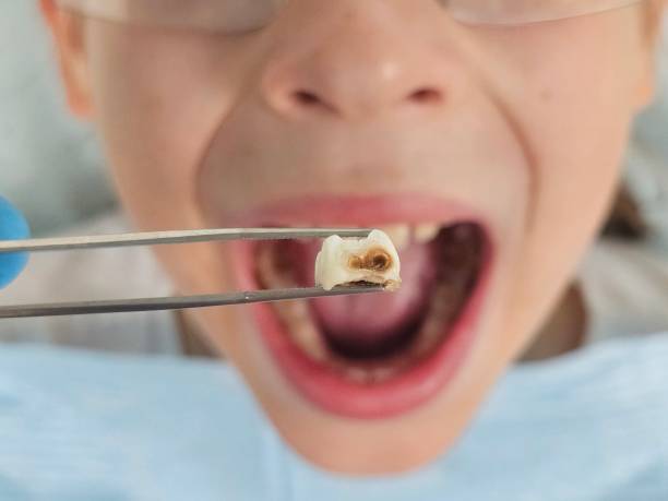 Best Emergency Tooth Extraction  in Lake Clarke Shores, FL